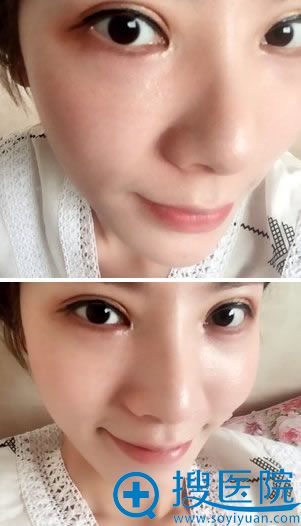 玻尿酸填充卧蚕手术第1天效果 玻尿酸填充卧蚕手术第1天效果