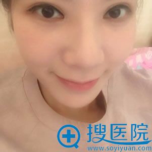 注微玻尿酸填充卧蚕第3天 注微玻尿酸填充卧蚕第3天