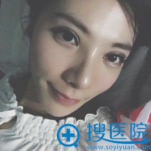 玻尿酸填充卧蚕微笑效果图 玻尿酸填充卧蚕微笑效果图
