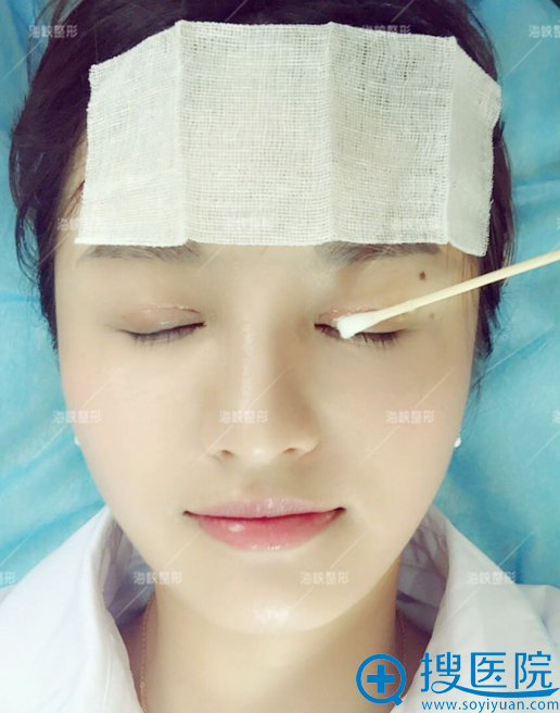 双眼皮术后7天拆线 双眼皮术后7天拆线
