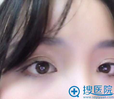 双眼皮术后18天的样子 双眼皮术后18天的样子