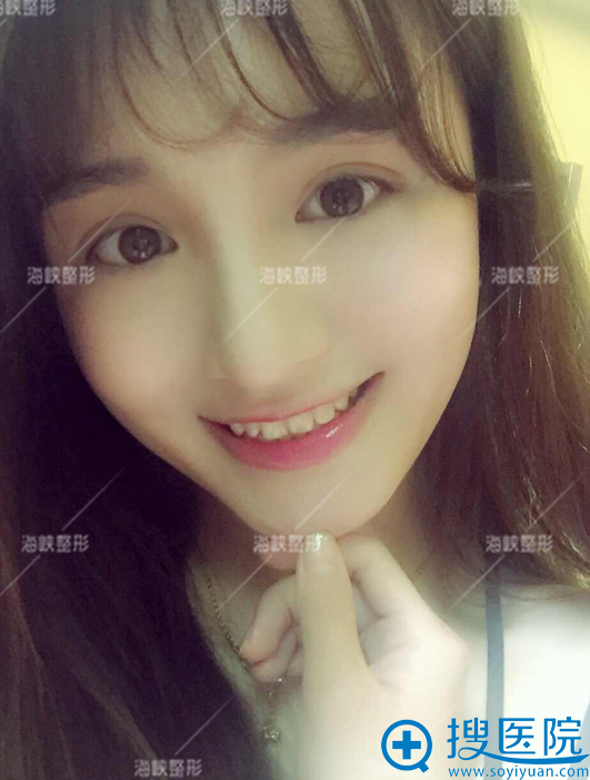 现在的我,双眼皮宛如天生 现在的我,双眼皮宛如天生