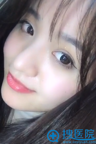 双眼皮术后32天生活照 双眼皮术后32天生活照