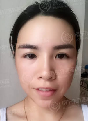 南宁东方专科医院自体纳米脂肪填充太阳穴和额头真实讲述