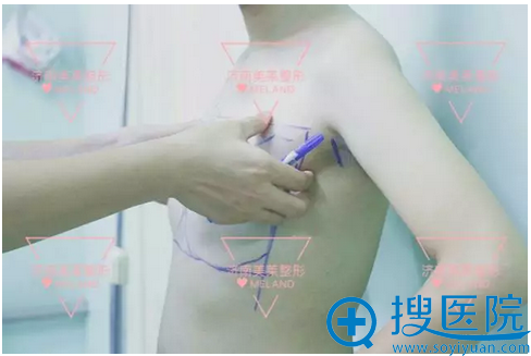 【亲身经历】看我花1万多找济南美莱汪峰做假体隆胸效果怎么样