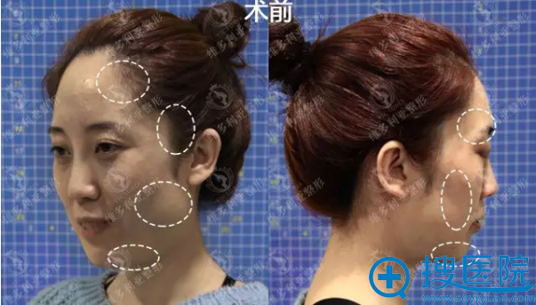 ����ά������������ȫ�沿����֬����䰸���ָ�Ч��ͼ����