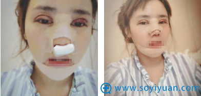 <!--<i data=20240710 data-id=12584></i>-->黄富伟全切双眼皮隆鼻隆下巴术前照术后即刻 <!--<i data=20240710 data-id=12584></i>-->黄富伟全切双眼皮隆鼻隆下巴术前照术后即刻