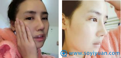 <!--<i data=20240710 data-id=12584></i>-->全切双眼皮隆鼻隆下巴术后6天 <!--<i data=20240710 data-id=12584></i>-->全切双眼皮隆鼻隆下巴术后6天