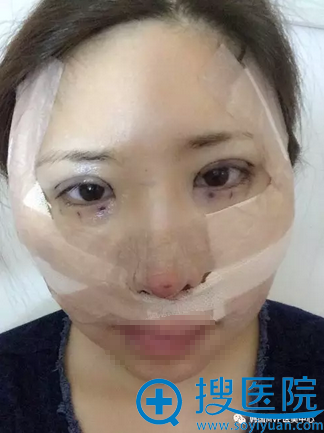 颧骨双眼皮隆鼻手术术后即刻效果 颧骨双眼皮隆鼻手术术后即刻效果