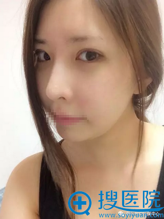 MVP整形医院颧骨双眼皮隆鼻术后1周照片 MVP整形医院颧骨双眼皮隆鼻术后1周照片