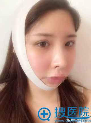 韩国MVP整形颧骨双眼皮隆鼻术后5天恢复效果 韩国MVP整形颧骨双眼皮隆鼻术后5天恢复效果