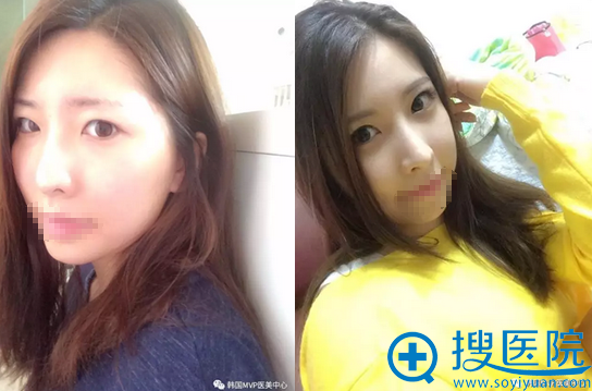 韩国MVP整形医院颧骨双眼皮隆鼻术后对比效果 韩国MVP整形医院颧骨双眼皮隆鼻术后对比效果