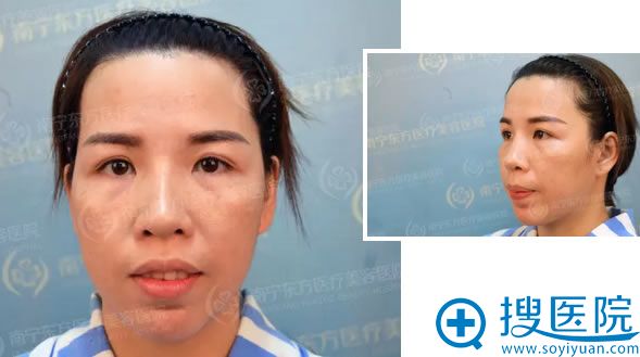 在南宁东方专科医院做脂肪填充前的样子 在南宁东方专科医院做脂肪填充前的样子