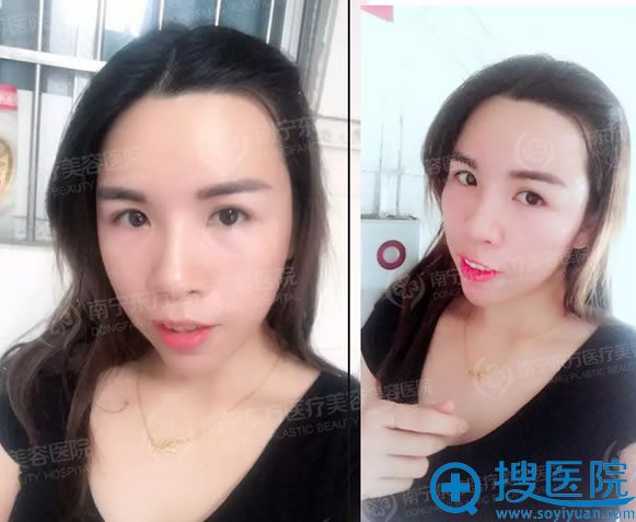 自体脂肪丰太阳穴术后两个月效果 自体脂肪丰太阳穴术后两个月效果
