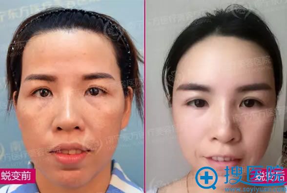 自体纳米脂肪填充太阳穴和额头前后对比图 自体纳米脂肪填充太阳穴和额头前后对比图