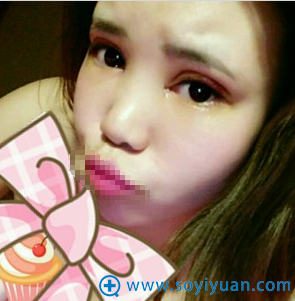 南京华美双眼皮+开眼角术后6天恢复图片 南京华美双眼皮+开眼角术后6天恢复图片