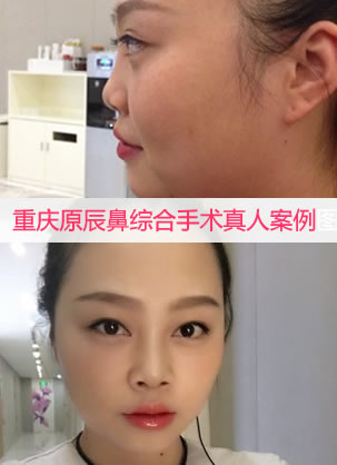 重庆原辰整形医院韦小勇医生鼻综合整形手术真人案例图