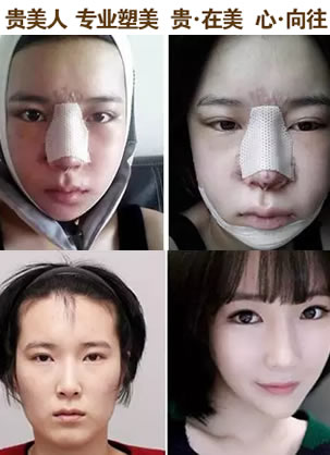 来看我在石家庄贵美人做双眼皮和鼻综合后的完美蜕变