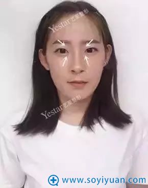 在杭州艺星整形医院做眼整形术前照 在杭州艺星整形医院做眼整形术前照