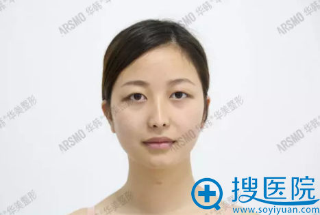 长沙华韩华美整形医院正规吗?好不好?双眼皮+鼻综合案例分享