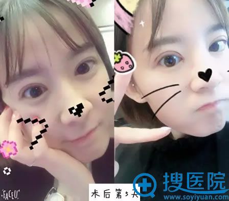 开眼角术后第5天恢复效果 开眼角术后第5天恢复效果
