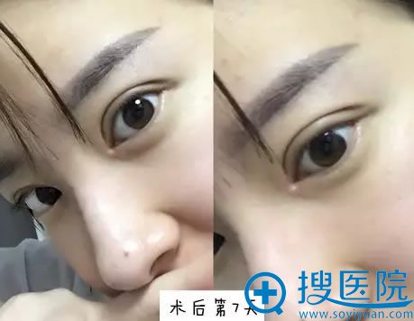 术后第7天拆过线的眼部美照 术后第7天拆过线的眼部美照