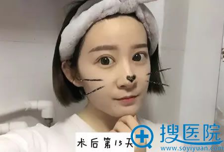 雷中元主任双眼皮案例15天效果图 雷中元主任双眼皮案例15天效果图