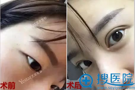 雷中元眼综合手术案例对比照 雷中元眼综合手术案例对比照