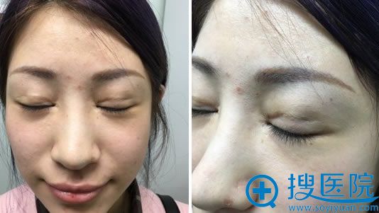 做双眼皮失败的照片 做双眼皮失败的照片