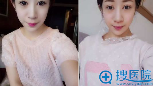 双眼皮修复手术1个月效果图 双眼皮修复手术1个月效果图