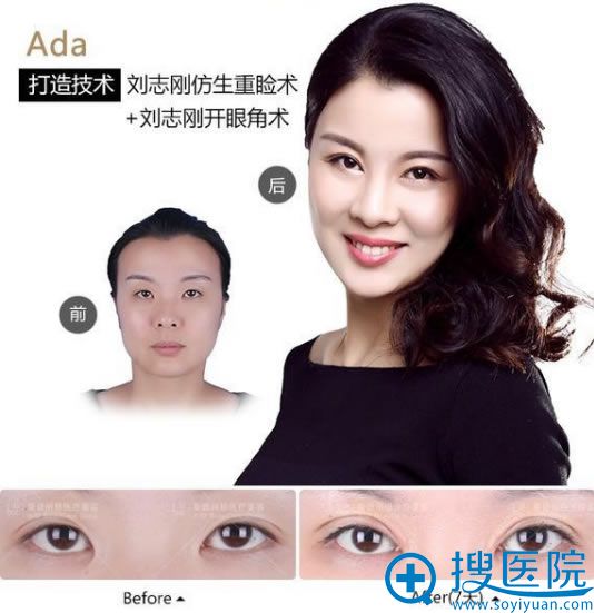 大连刘志刚做眼睛整形代表案例 大连刘志刚做眼睛整形代表案例