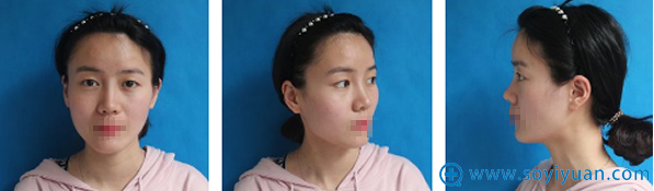 <!--<i data=20240710 data-id=12323></i>-->黄蕾埋线双眼皮术前照 <!--<i data=20240710 data-id=12323></i>-->黄蕾埋线双眼皮术前照