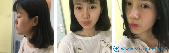 <!--<i data=20240710 data-id=12323></i>-->黄蕾埋线双眼皮术后即可效果 <!--<i data=20240710 data-id=12323></i>-->黄蕾埋线双眼皮术后即可效果
