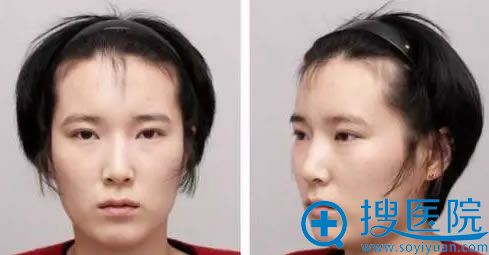 在石家庄贵美人医院做整形术前照 在石家庄贵美人医院做整形术前照