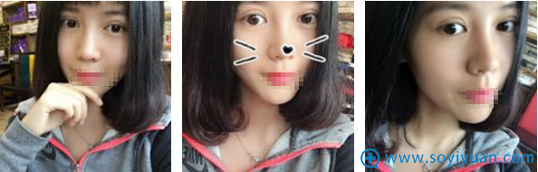 黄蕾埋线双眼皮术后10天恢复照片 黄蕾埋线双眼皮术后10天恢复照片