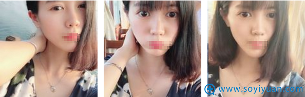 黄蕾埋线双眼皮术后44天恢复效果 黄蕾埋线双眼皮术后44天恢复效果
