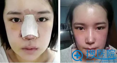 双眼皮术后拆线的样子 双眼皮术后拆线的样子