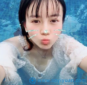 <!--<i data=20240710 data-id=12323></i>-->黄蕾埋线双眼皮术后3个月恢复照 <!--<i data=20240710 data-id=12323></i>-->黄蕾埋线双眼皮术后3个月恢复照
