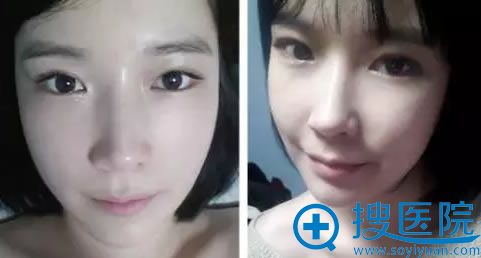 眼鼻综合整形术后一个月恢复效果 眼鼻综合整形术后一个月恢复效果