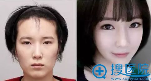 做完面部轮廓和双眼皮前后对比照 做完面部轮廓和双眼皮前后对比照