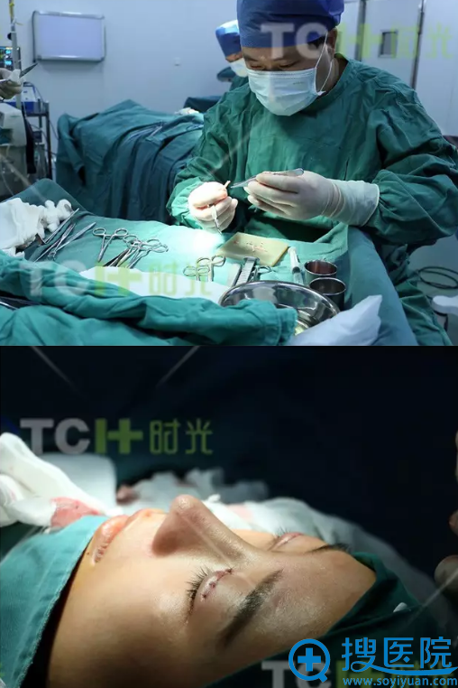 隆鼻术后即刻效果 隆鼻术后即刻效果
