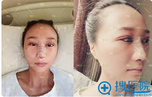 双眼皮+隆鼻术后第二天效果 双眼皮+隆鼻术后第二天效果