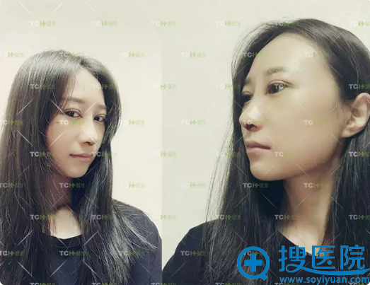 在杭州时光做完眼鼻综合第五天生活照 在杭州时光做完眼鼻综合第五天生活照