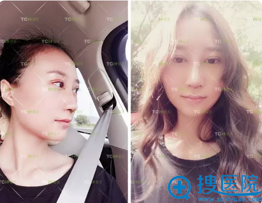找吴艾竞做完眼鼻综合第六天自拍 找吴艾竞做完眼鼻综合第六天自拍