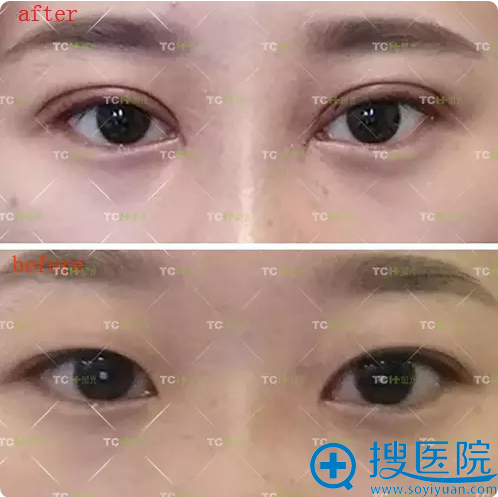 杭州时候眼综合术后7天特写 杭州时候眼综合术后7天特写