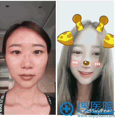 做完眼鼻综合前后对比照片 做完眼鼻综合前后对比照片