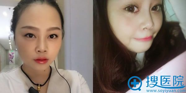 塌鼻子做整形手术1个月照片 塌鼻子做整形手术1个月照片