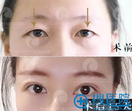 <!--<i data=20240710 data-id=12625></i>-->刘明飞双眼皮前后对比案例 <!--<i data=20240710 data-id=12625></i>-->刘明飞双眼皮前后对比案例