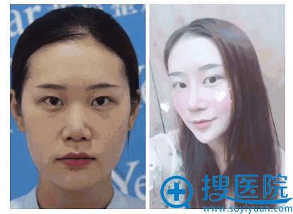 隆鼻前后对比图 隆鼻前后对比图