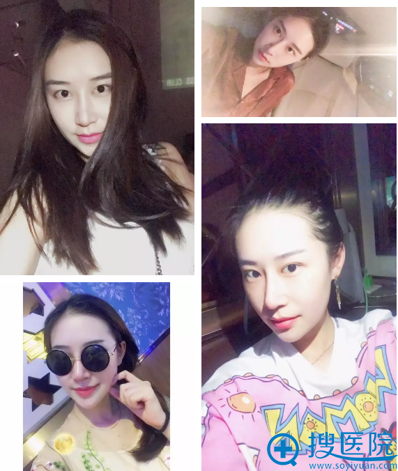 隆鼻术后变身小仙女 隆鼻术后变身小仙女